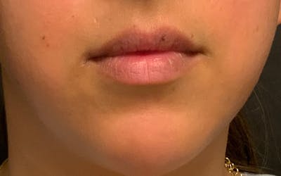 Restylane Before & After Gallery - Patient 357963 - Image 1