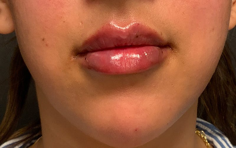 Restylane Before & After Gallery - Patient 357963 - Image 2