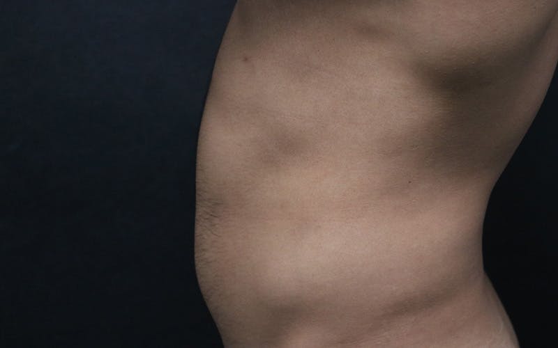 Liposuction Before & After Gallery - Patient 150830 - Image 3