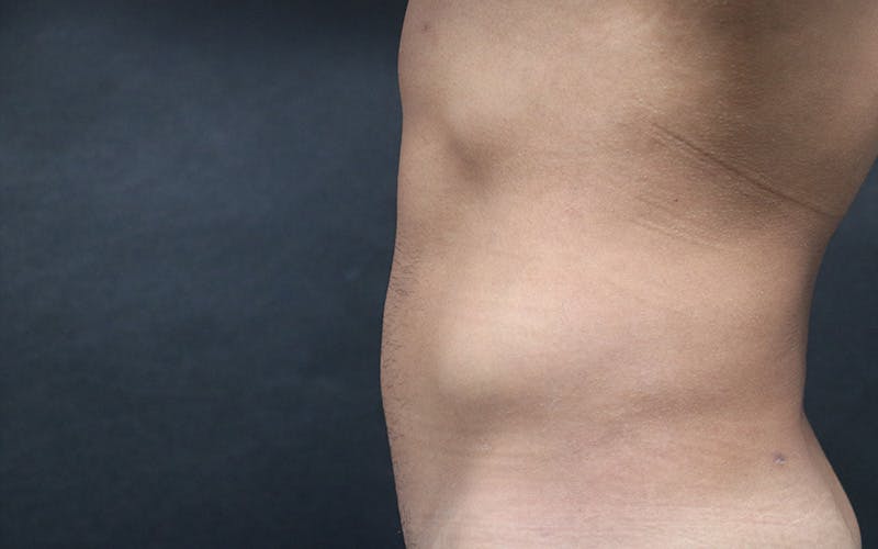Liposuction Before & After Gallery - Patient 150830 - Image 4