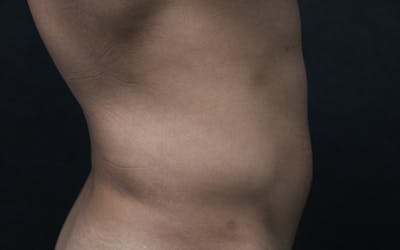 Liposuction Before & After Gallery - Patient 150830 - Image 1