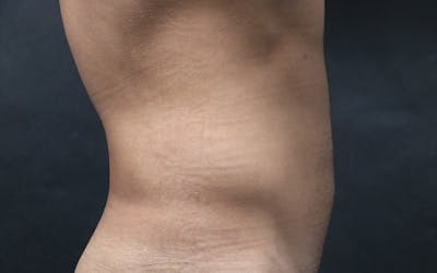 Liposuction Before & After Gallery - Patient 150830 - Image 2
