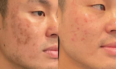 VI Peel Before & After Gallery - Patient 247552 - Image 1