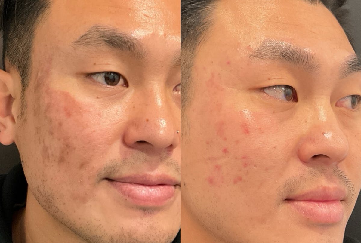 VI Peel Before & After Gallery - Patient 247552 - Image 2