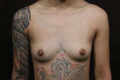 Breast Augmentation Before & After Gallery - Patient 620499 - Image 1