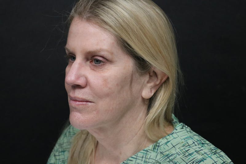 Facelift Before & After Gallery - Patient 195334 - Image 1