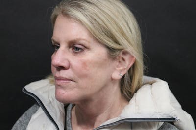 Facelift Before & After Gallery - Patient 195334 - Image 2