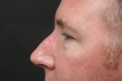 Rhinoplasty Before & After Gallery - Patient 178115 - Image 1