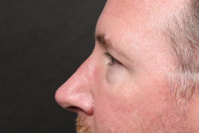 Rhinoplasty Before & After Gallery - Patient 178115 - Image 2
