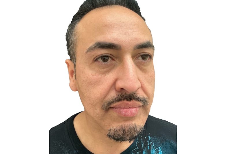 Radiesse Before & After Gallery - Patient 368353 - Image 1