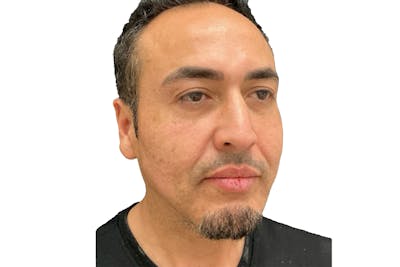 Radiesse Before & After Gallery - Patient 368353 - Image 2