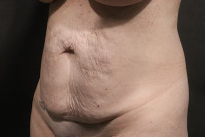 Tummy Tuck Before & After Gallery - Patient 253193 - Image 1