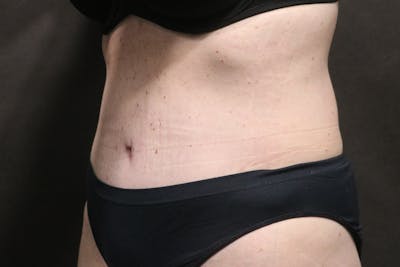 Tummy Tuck Before & After Gallery - Patient 253193 - Image 2
