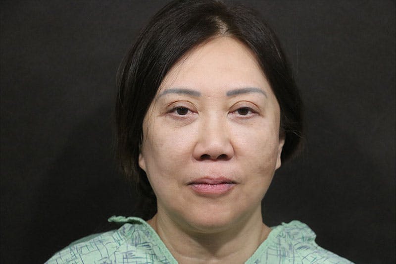 Facelift Before & After Gallery - Patient 140306 - Image 1