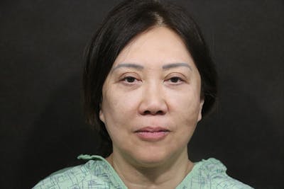 Facelift Before & After Gallery - Patient 140306 - Image 1