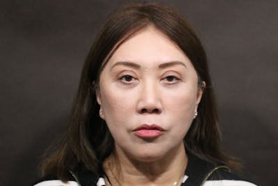 Facelift Before & After Gallery - Patient 140306 - Image 2