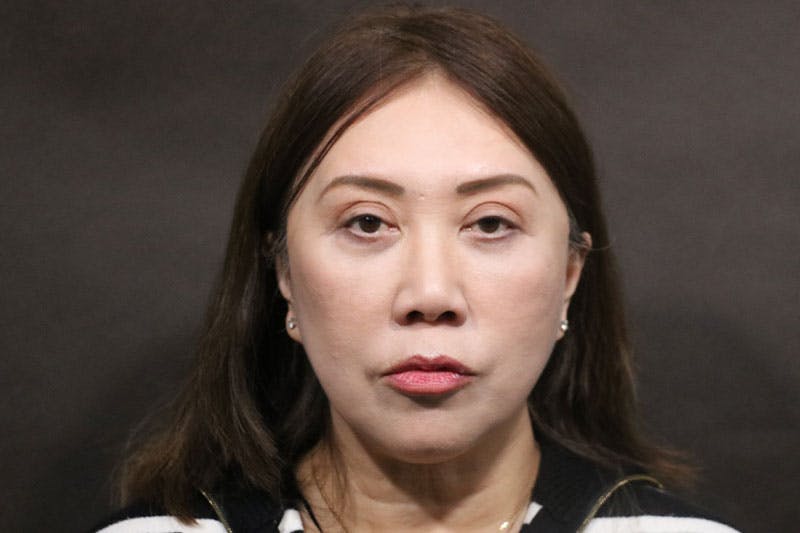 Facelift Before & After Gallery - Patient 140306 - Image 2