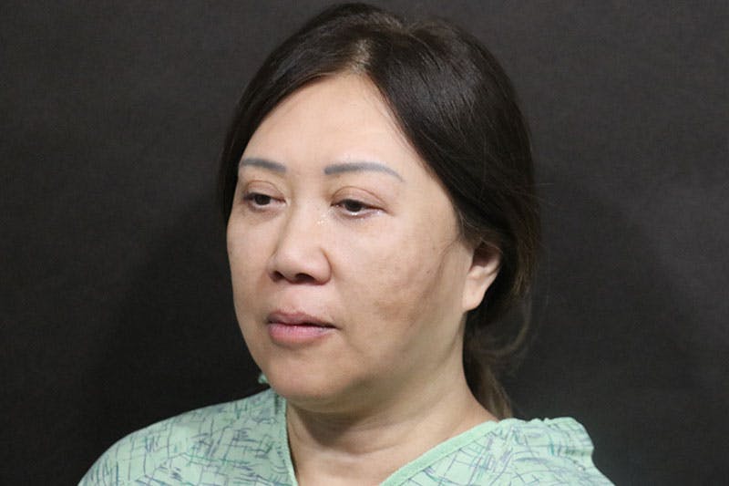 Facelift Before & After Gallery - Patient 140306 - Image 3