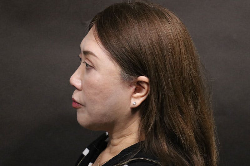 Facelift Before & After Gallery - Patient 140306 - Image 6