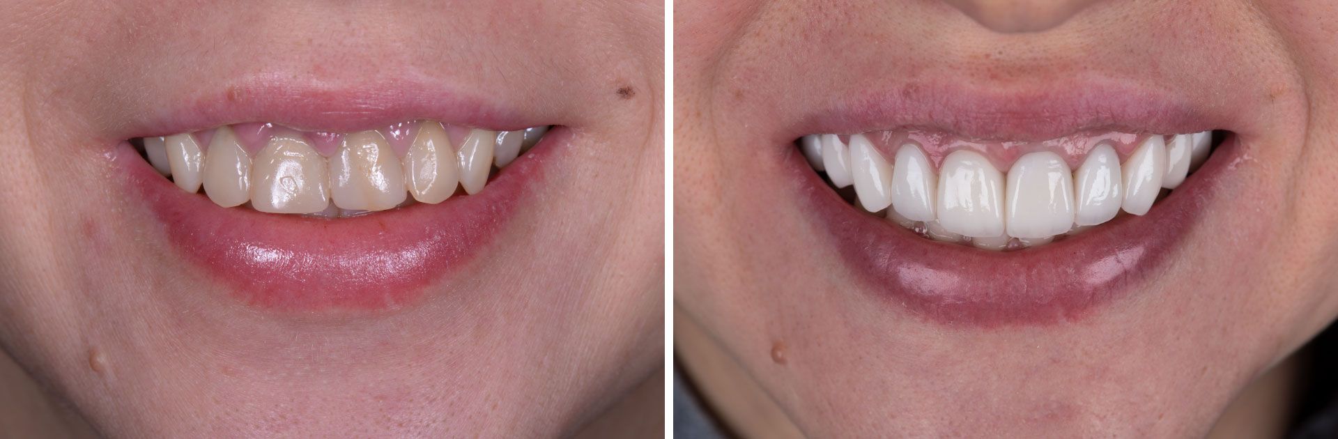 Veneers before and after