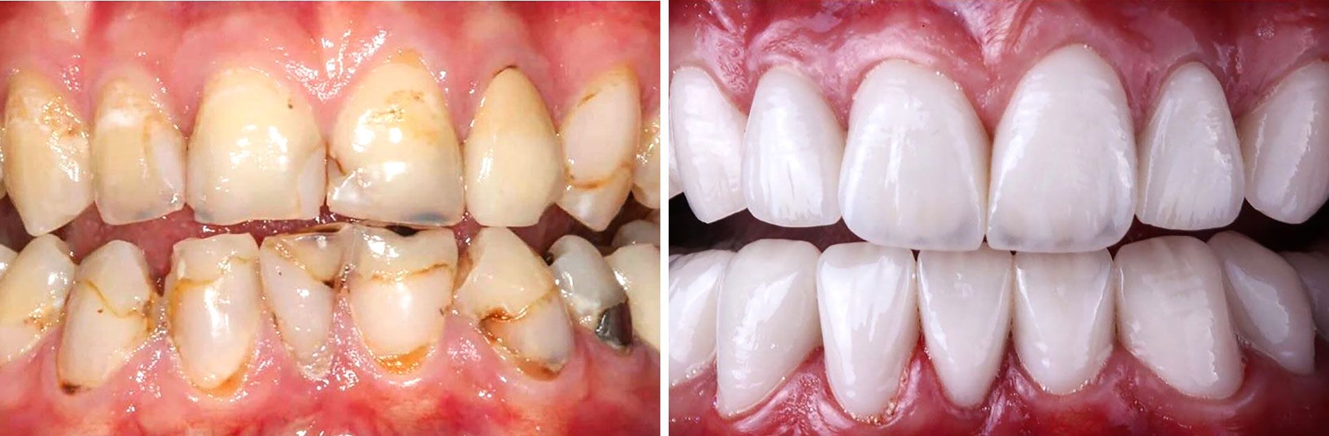 Veneers and smile makeover before and after