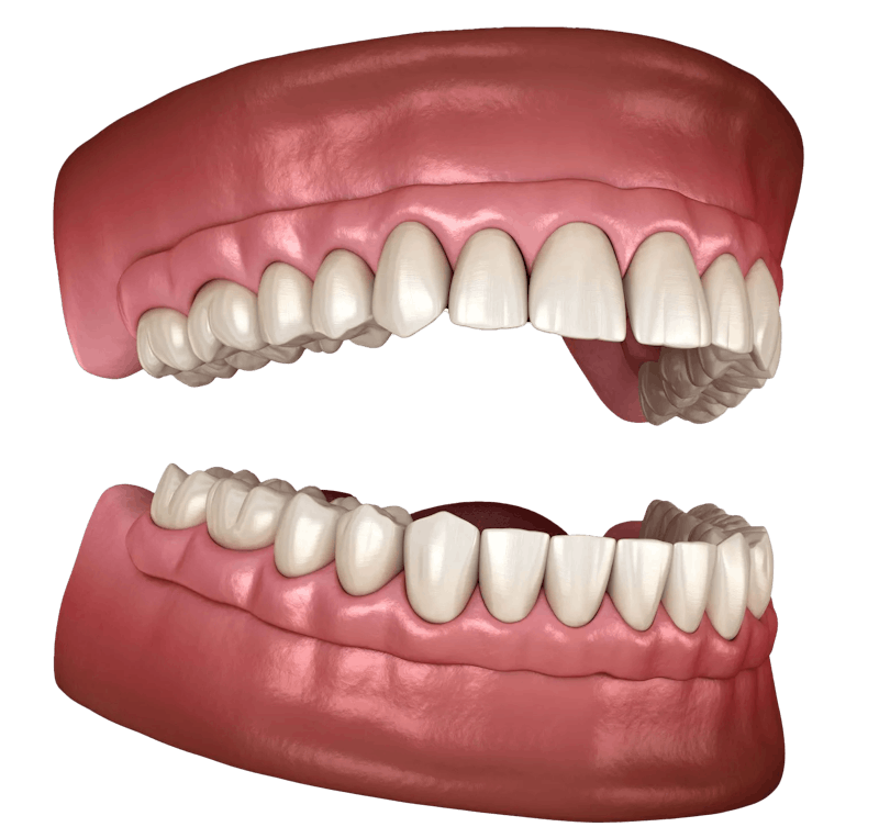 Complete denture