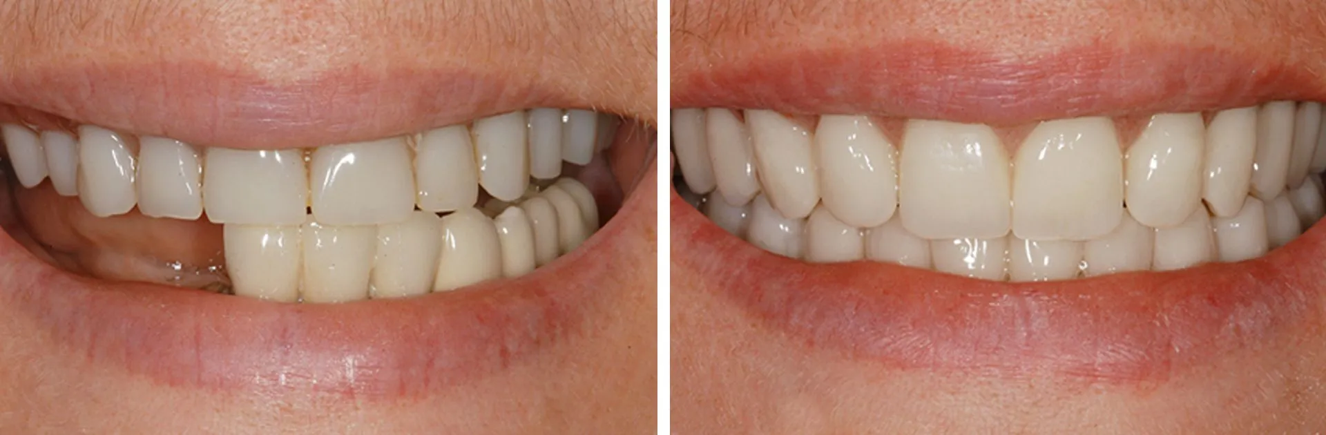 Dentures before and after