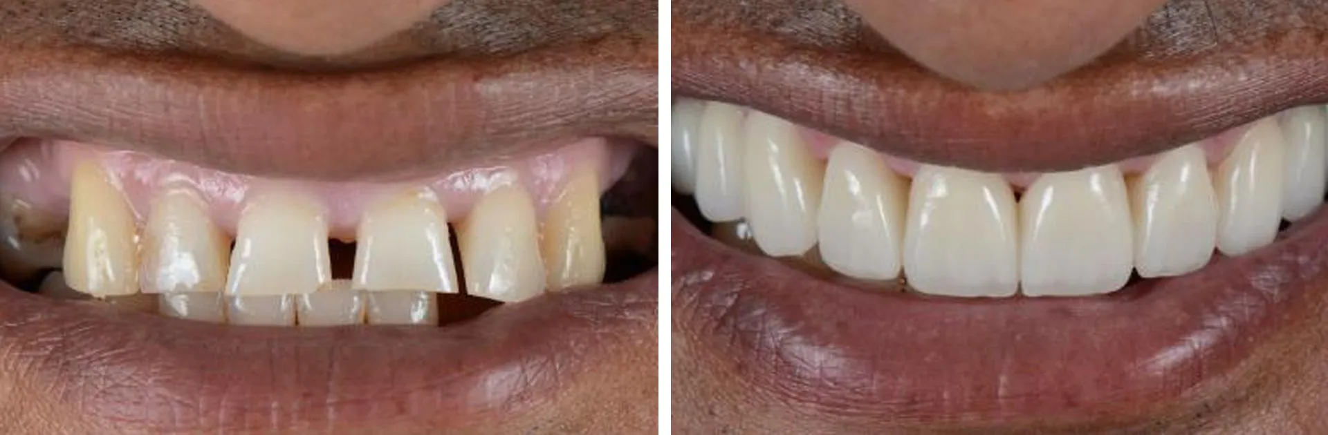 Dentures before and after