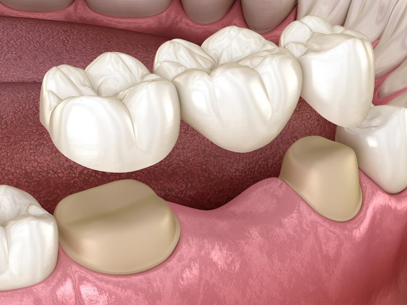 Dental bridge