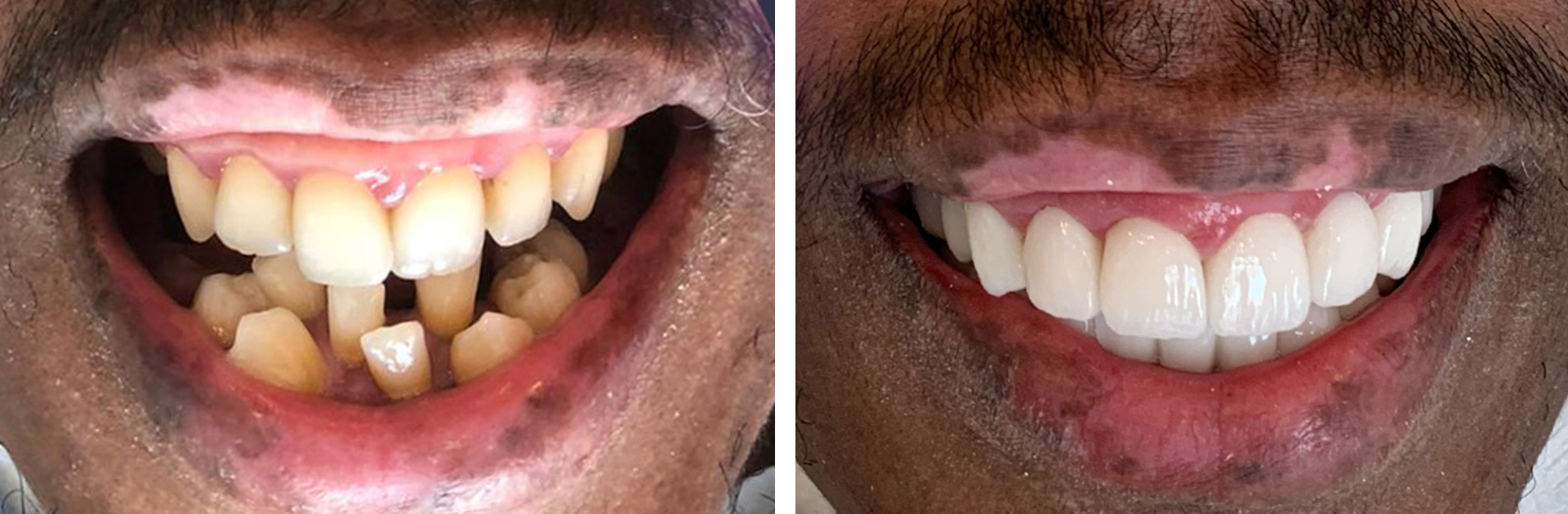 Dental implants before and after