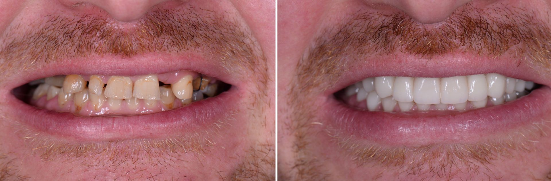 Smile makeover before and after
