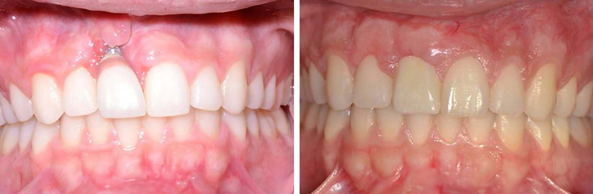 Dental implant repair before and after