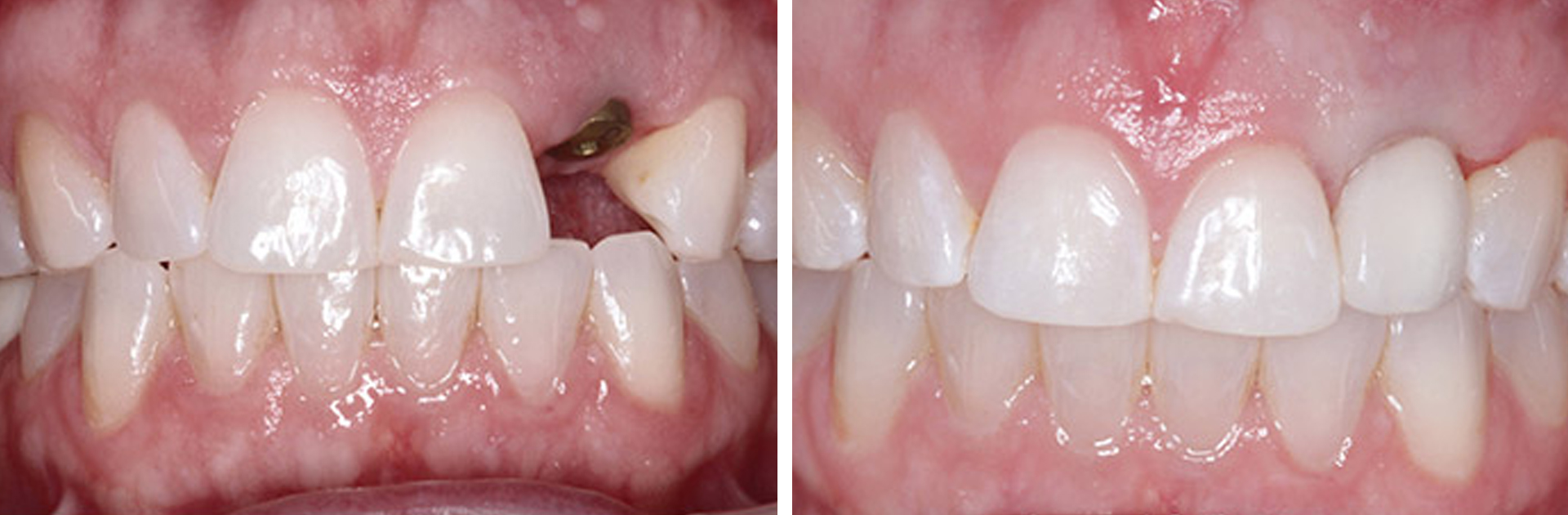 Dental implant before and after result