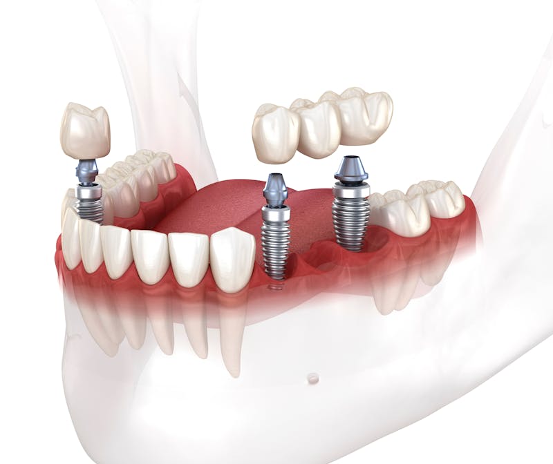 Multiple dental implants