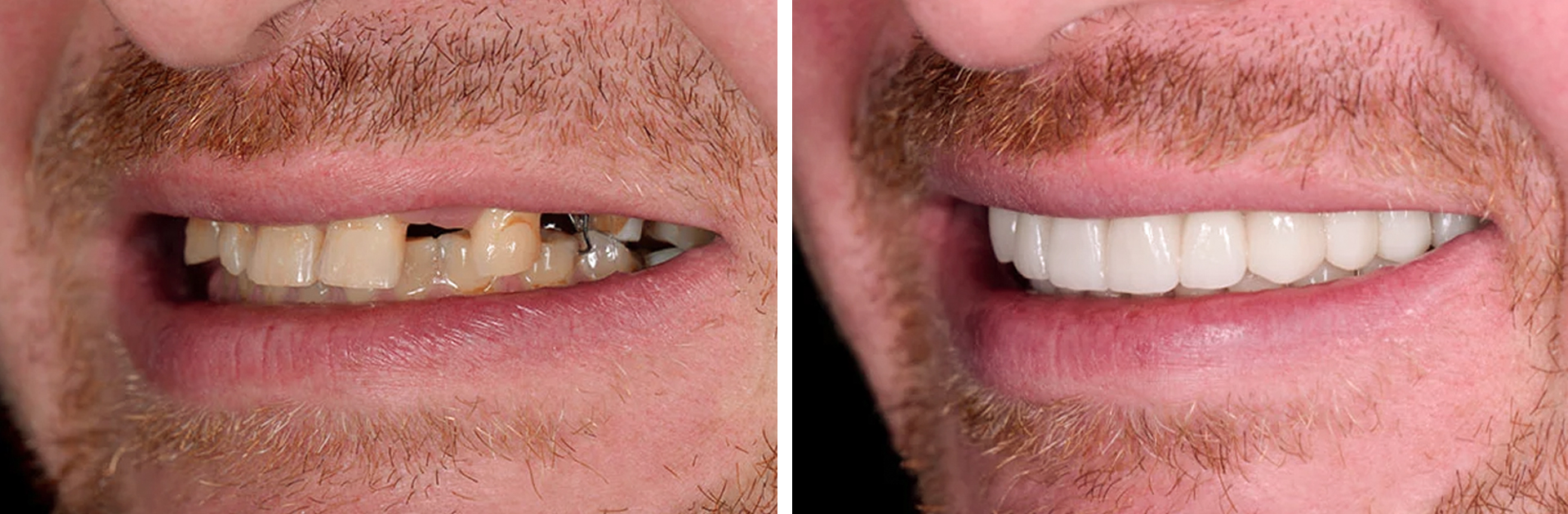 Dental implants before and after result