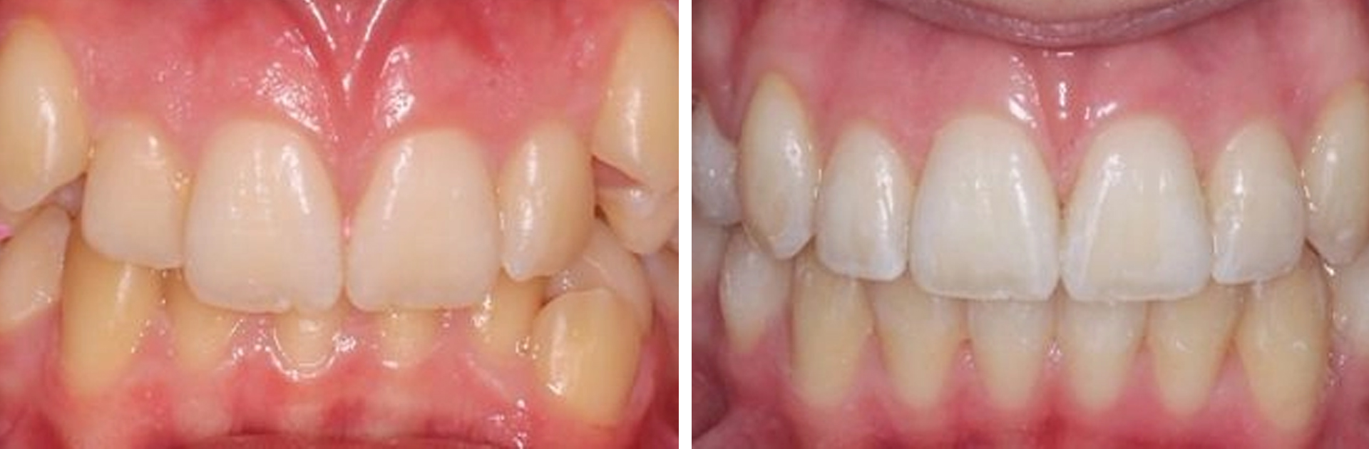 Braces before and after result