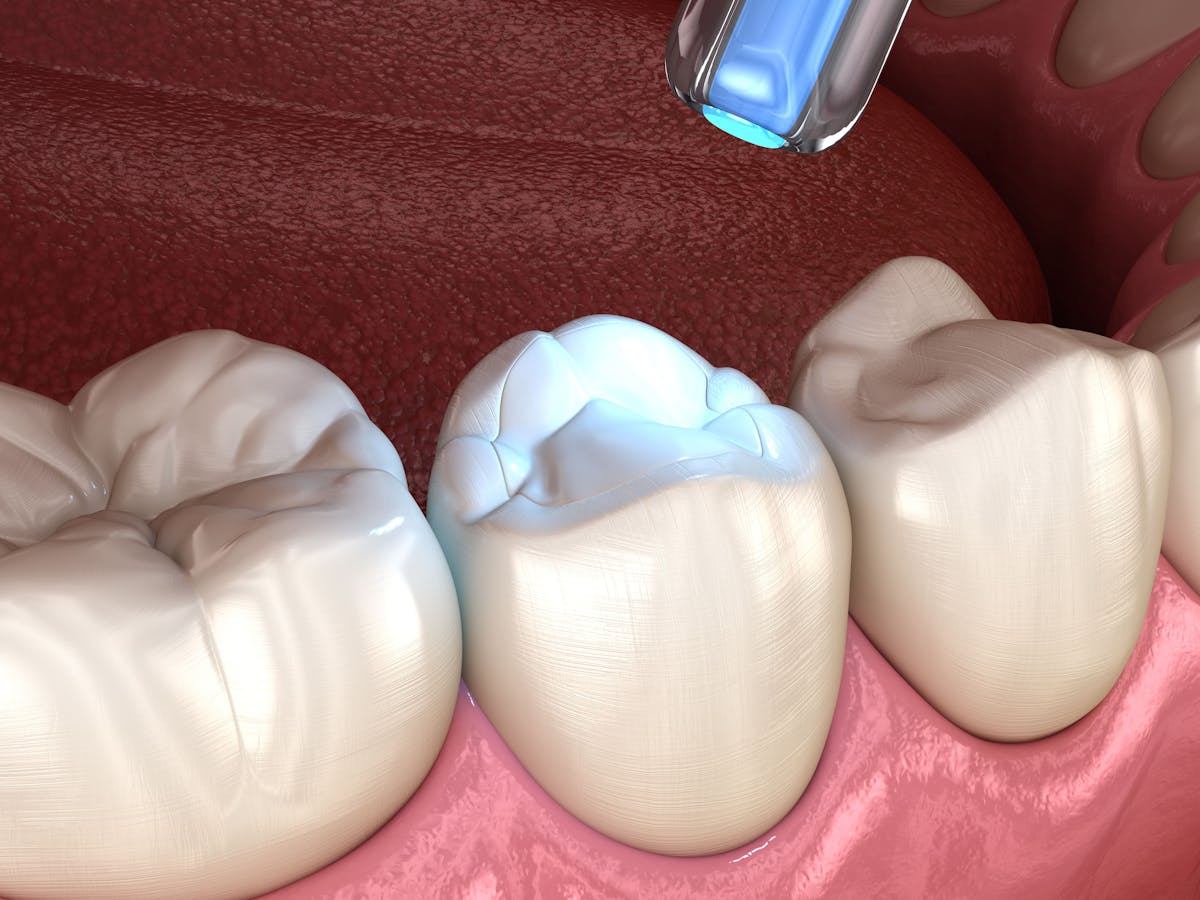 Dental Bonding Process