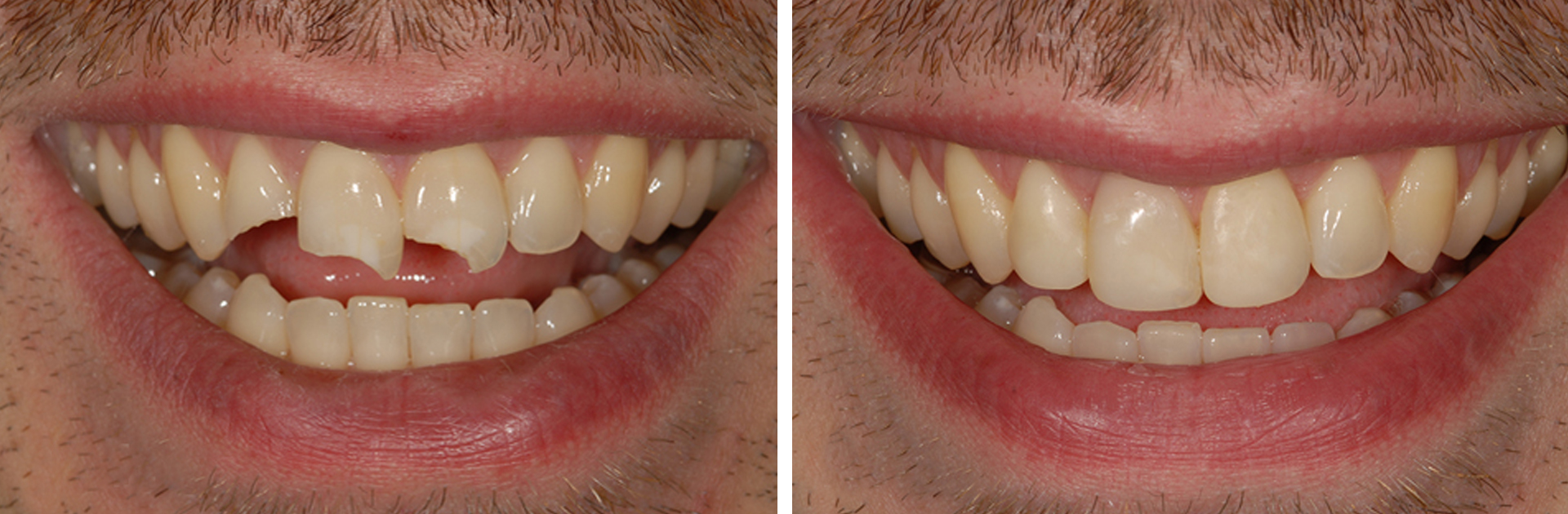 Dental Bonding Before and After