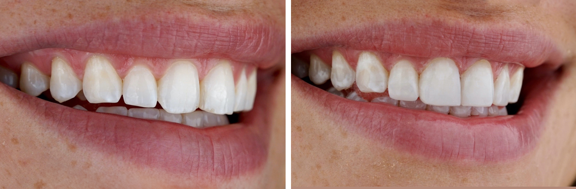 Before and After Dental Bonding