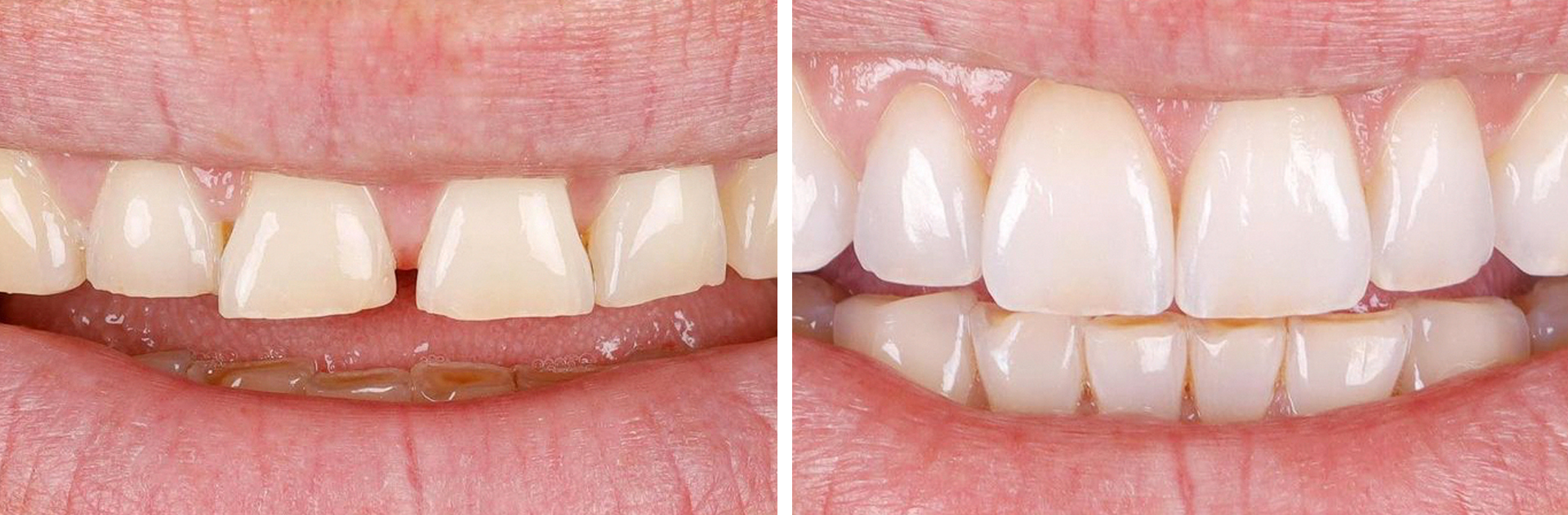 Teeth Crown Before and After Result