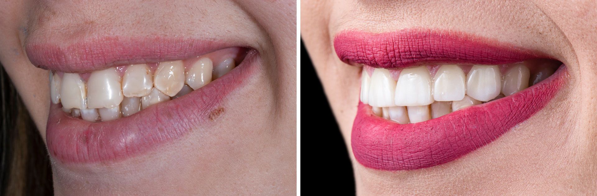Before and After of Veneers and Crown