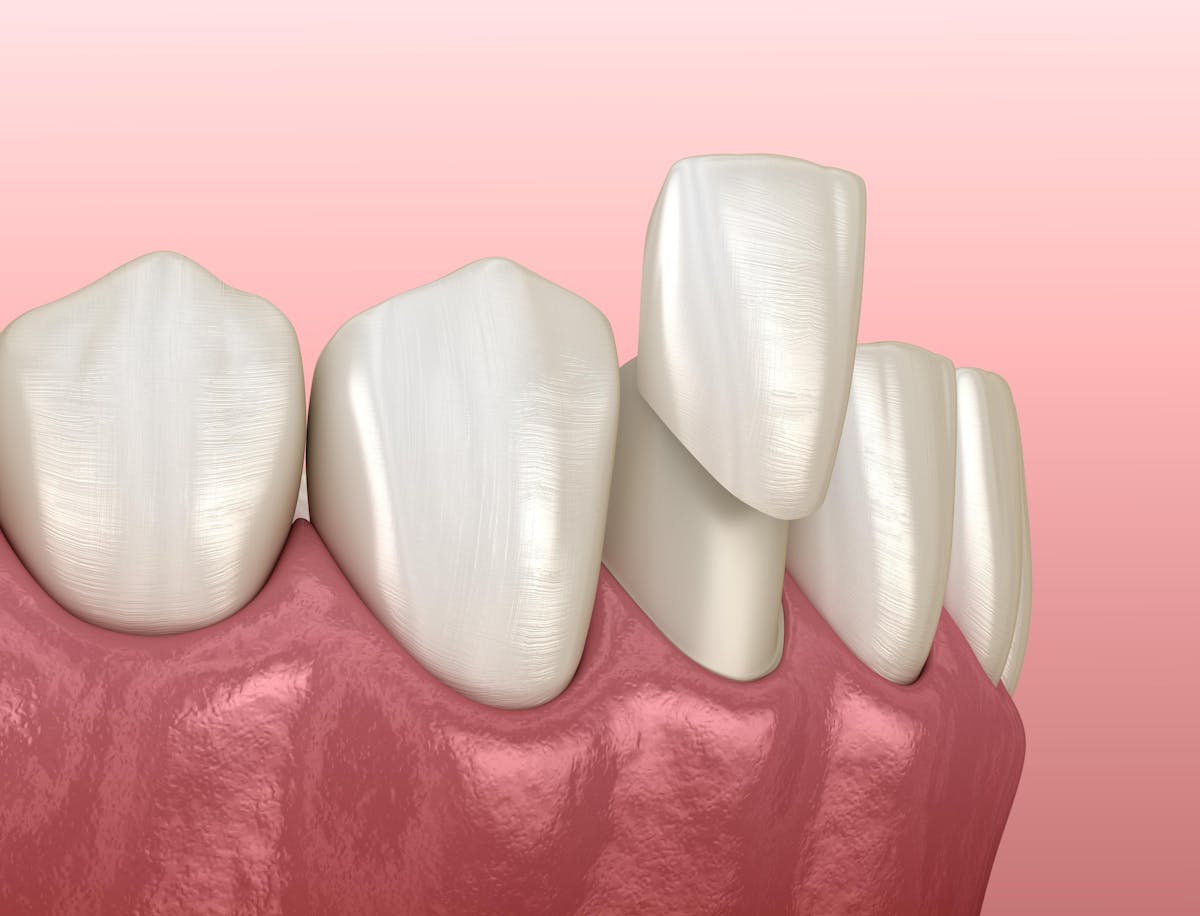 Dental Veneer