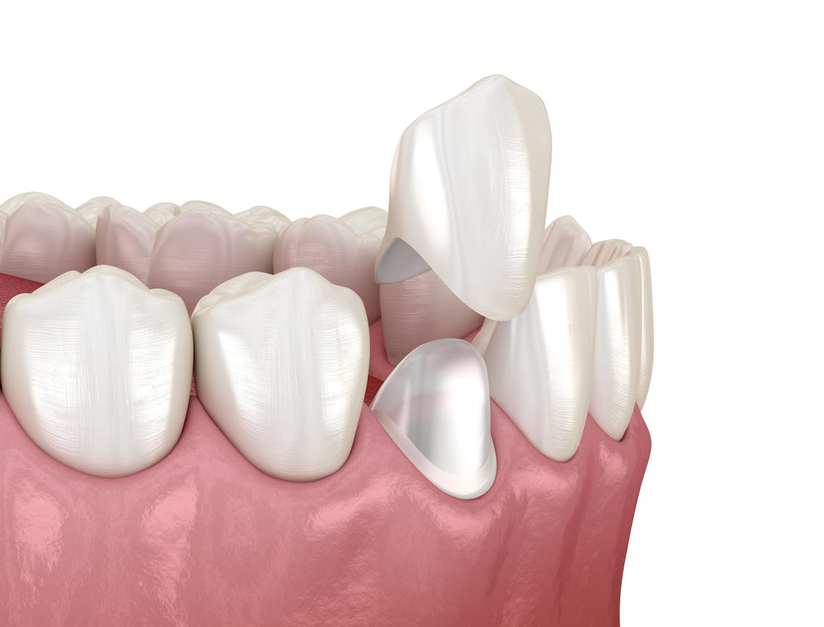 Dental Crown Image