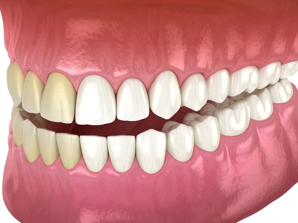 Teeth Whitening Model