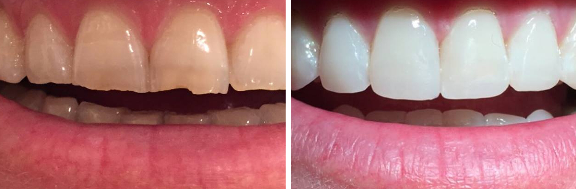 Before and After Result of Teeth Recontouring