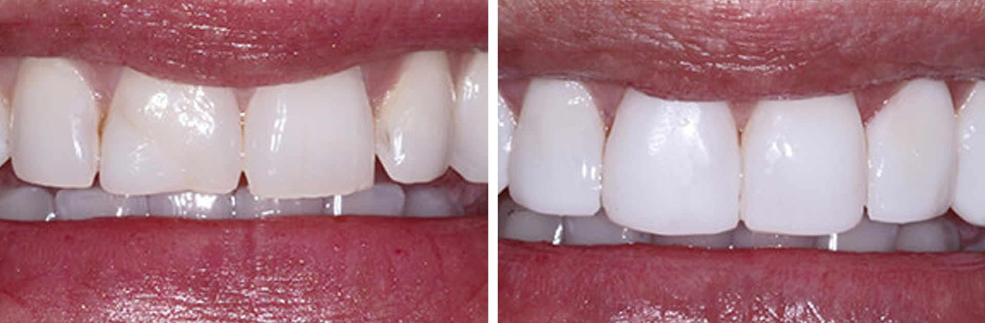 Before and After Result of Teeth Recontouring