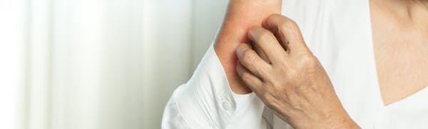 woman scratching her arm