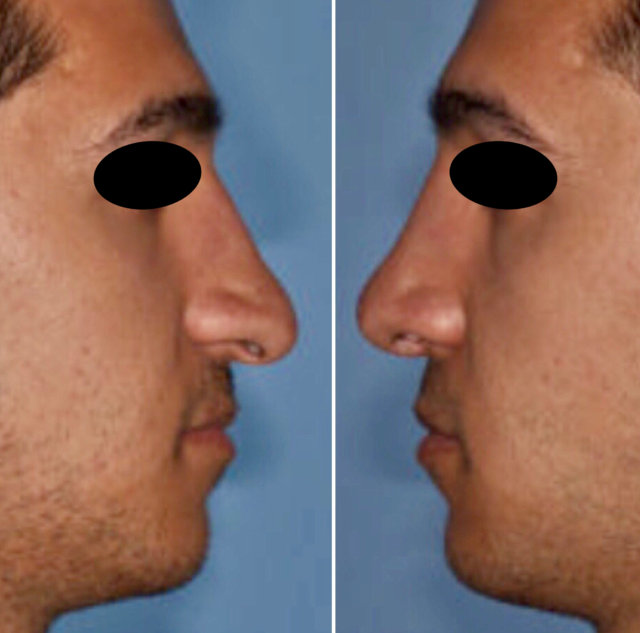 Before and after revision rhinoplasty 