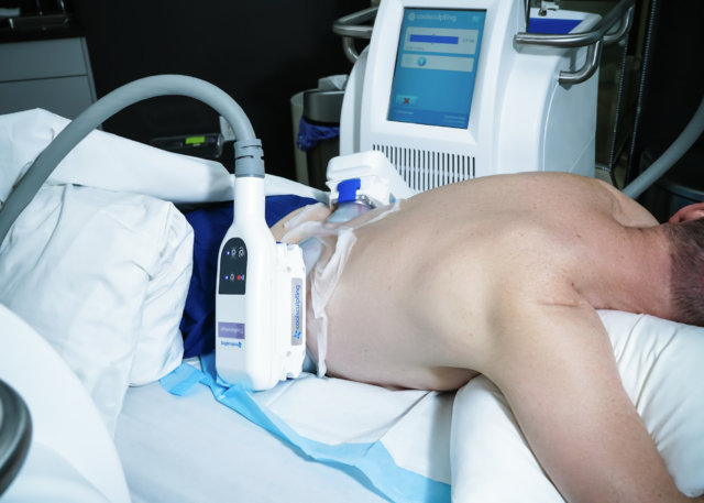 Person recieving CoolSculpting treatment