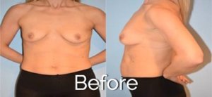 Before breast procedure